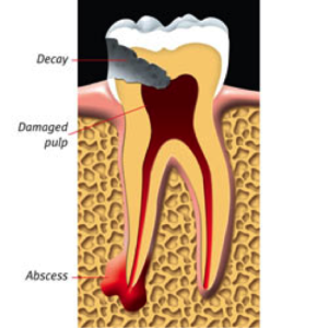 root-canal-kingston-dentist-westwoods-dental-abscessed-tooth