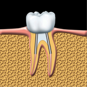 root-canal-kingston-dentist-westwoods-dental-crown-is-cemented-into-place