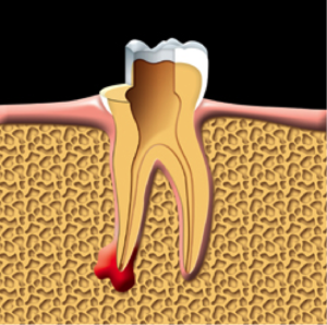 root-canal-kingston-dentist-westwoods-dental-damaged-pulp-is-removed