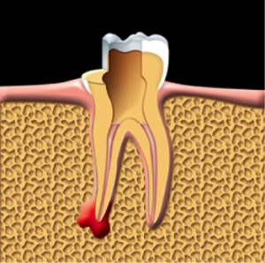 root-canal-kingston-dentist-westwoods-dental-root-canals-are-filled-and-sealed