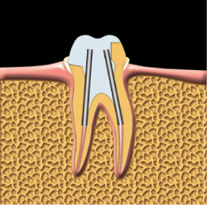 root-canal-kingston-dentist-westwoods-dental-tooth-prepared-for-crown